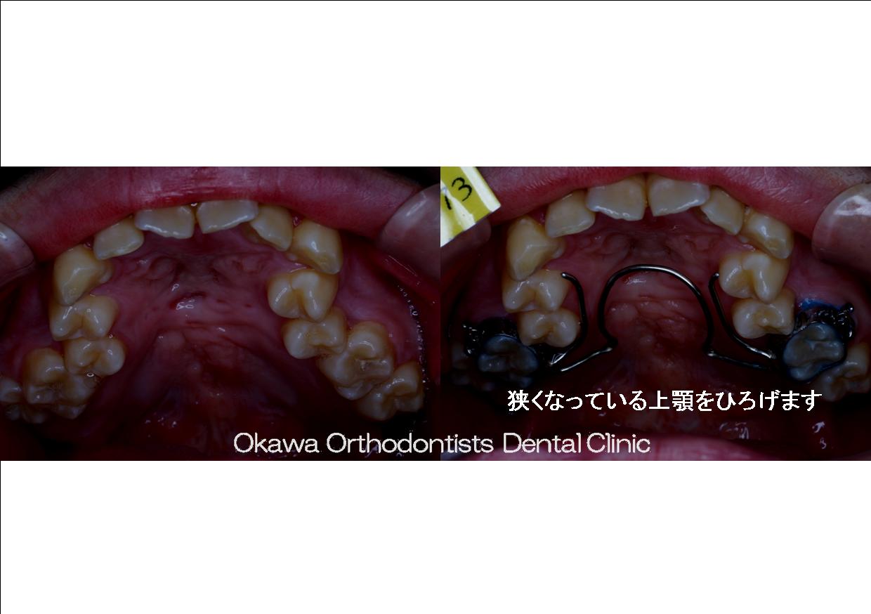 3. 長く感じた（？）矯正治療の Before 画像