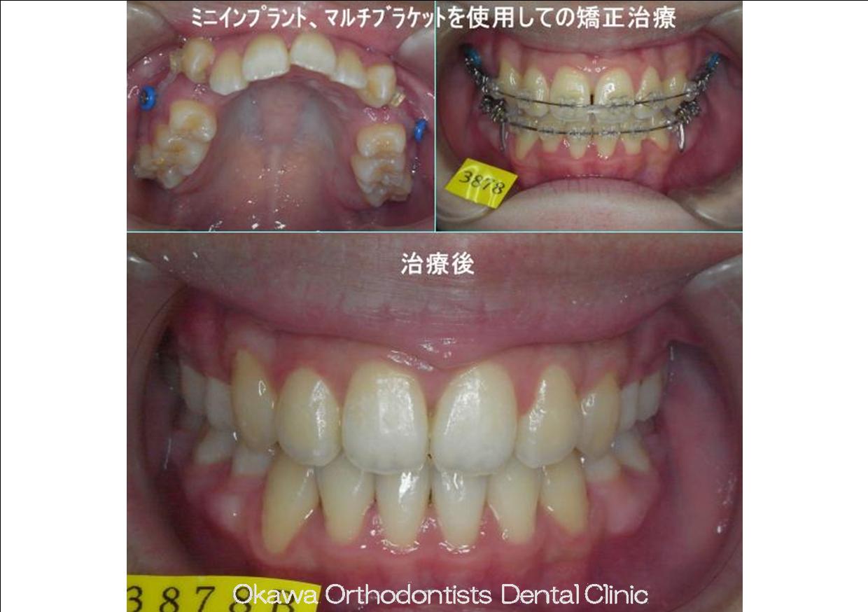 20. アンカースクリューを使った治療の After 画像