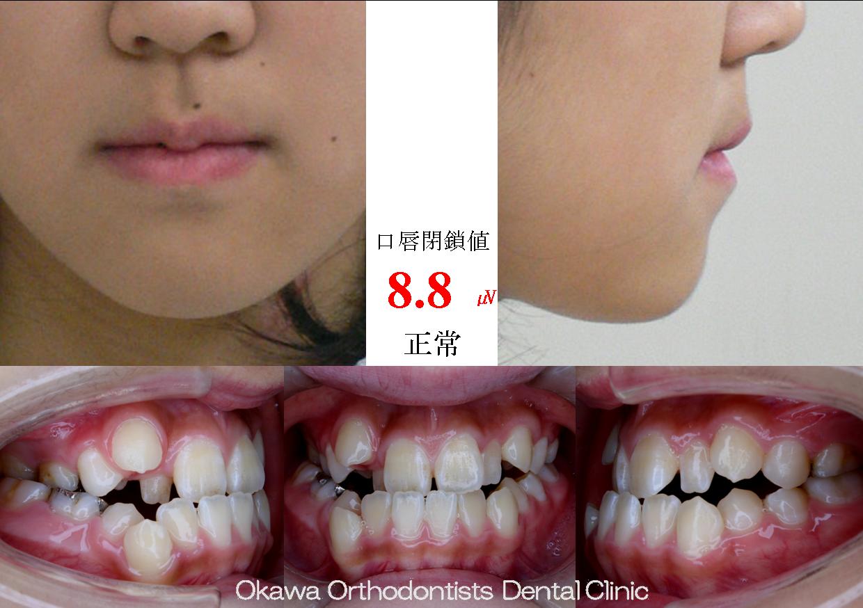 49. 長期間の成長観察の Before 画像