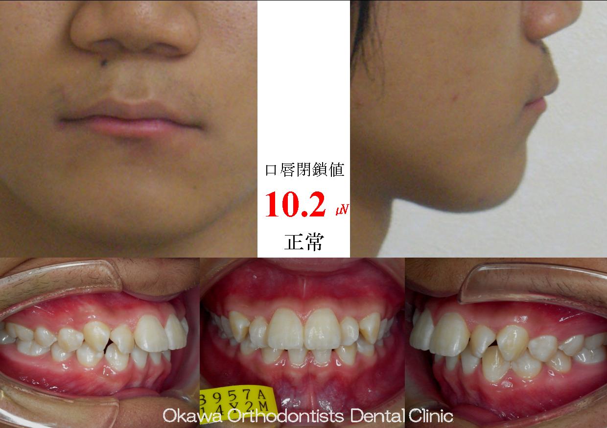 53. 下顎前歯が2本足りない出っ歯の Before 画像