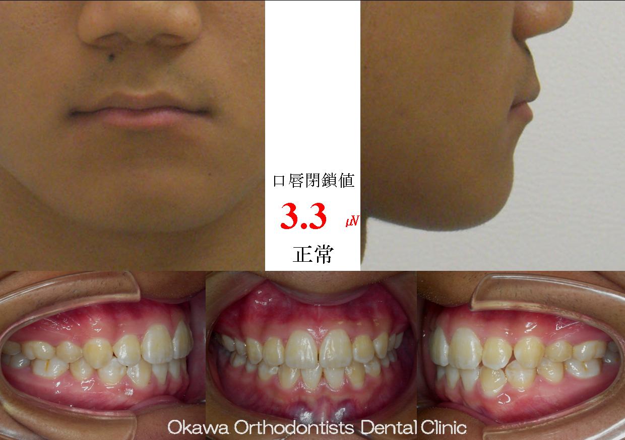 53. 下顎前歯が2本足りない出っ歯の After 画像