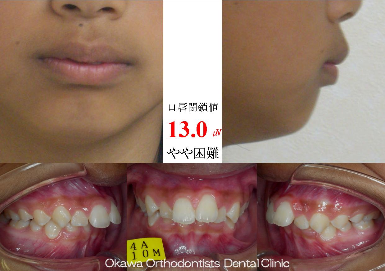 43. 下の前歯が2本しかない出っ歯の Before 画像