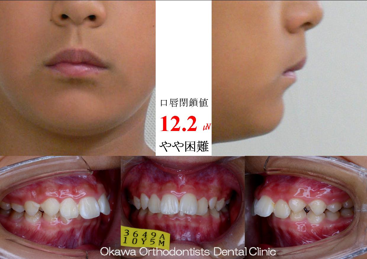 59. 口元が出ていないので非抜歯の Before 画像
