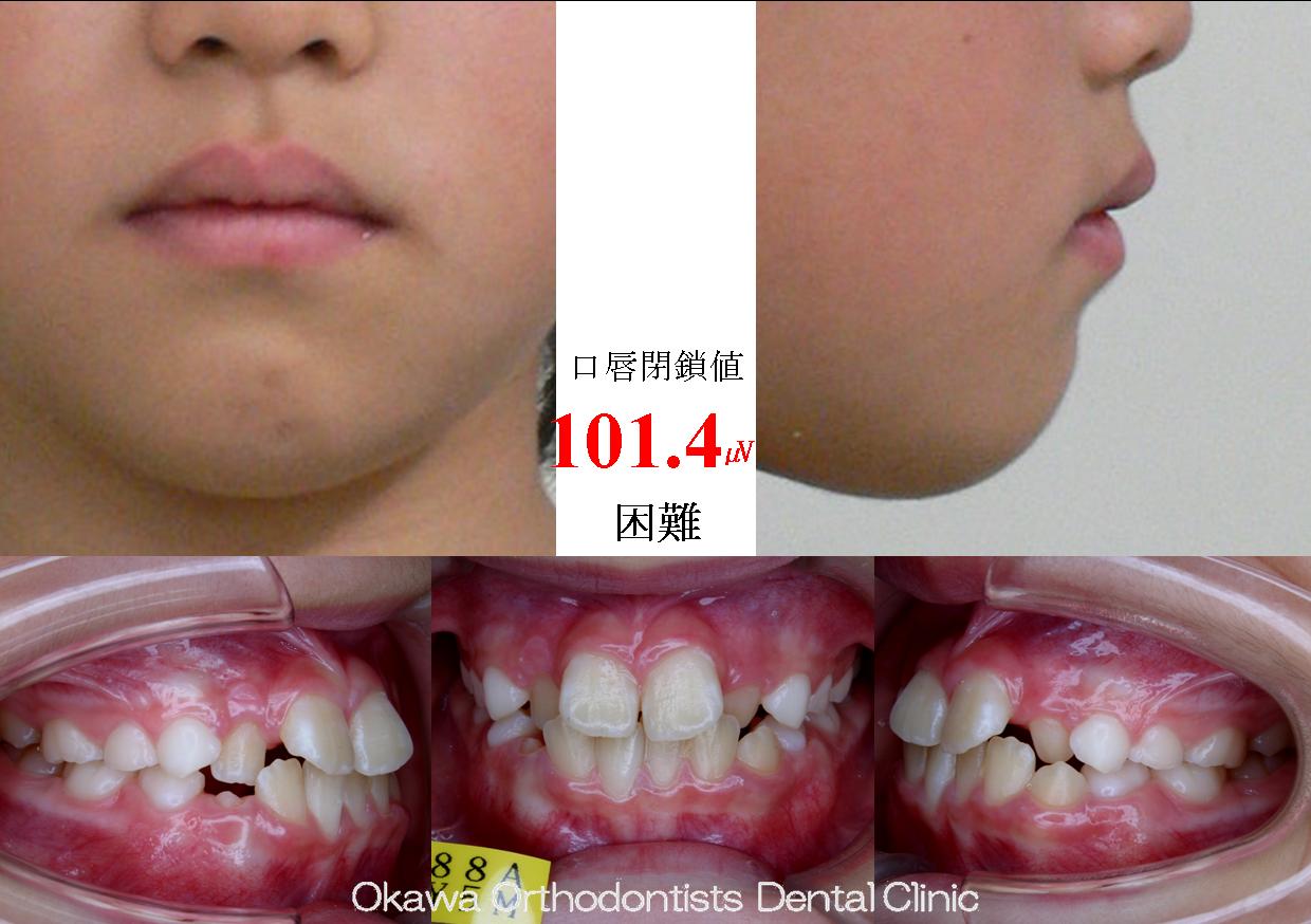 58. 1期治療で十分なのように思えたがの Before 画像