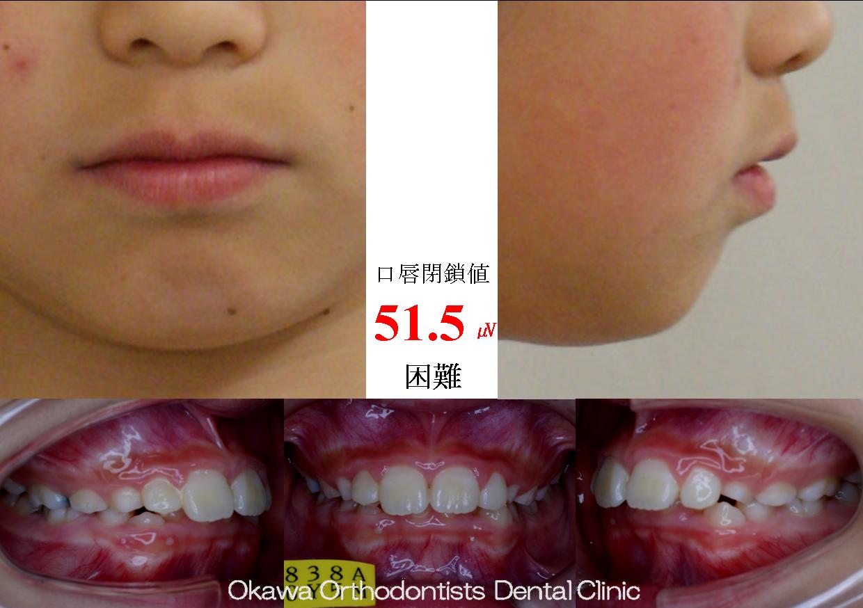 63. 抜歯に変更の Before 画像