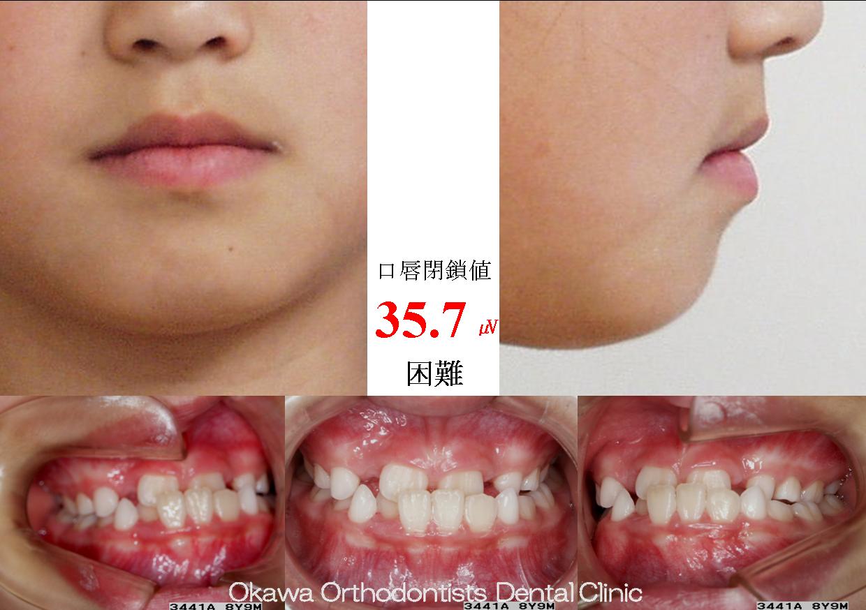 74. ８歳から始めた矯正の Before 画像