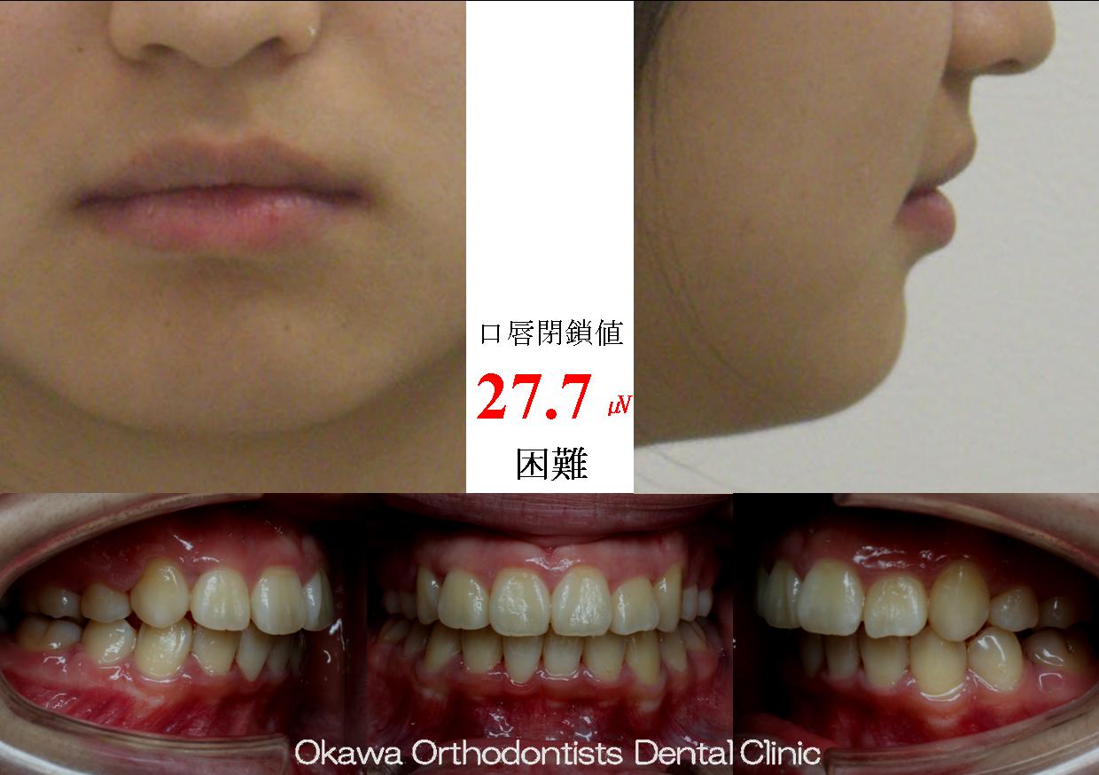 74. ８歳から始めた矯正の After 画像