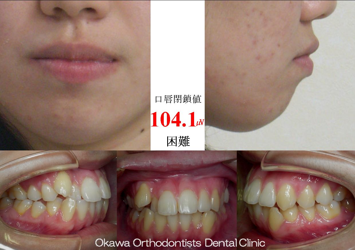 84. 八重歯、出っ歯が長年気になっていたの Before 画像