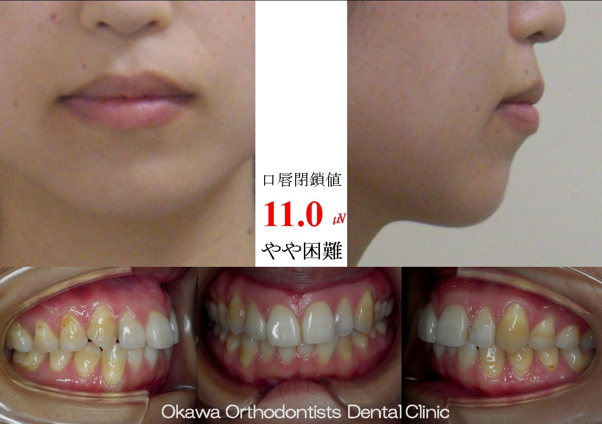 85.　軽度な叢生だが治したくての Before 画像
