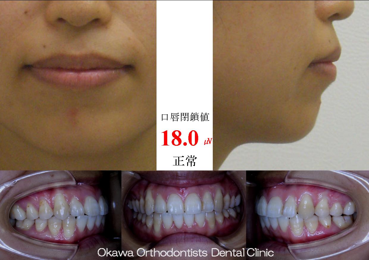 85.　軽度な叢生だが治したくての After 画像
