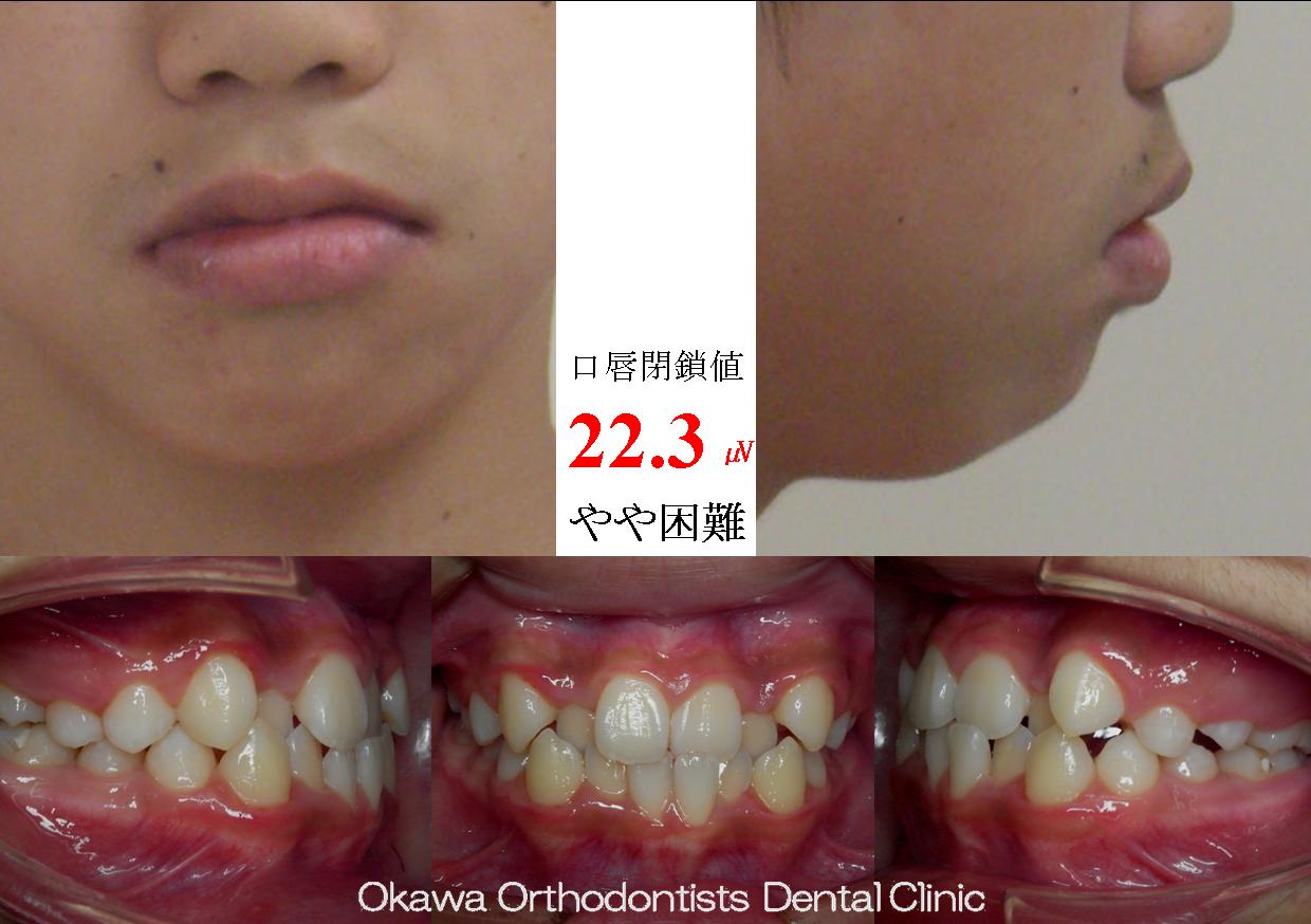 93. 母、妹も当院にて矯正の Before 画像