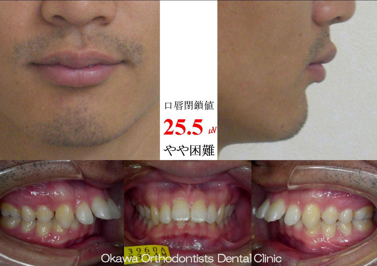 91．非抜歯治療の限界の Before 画像