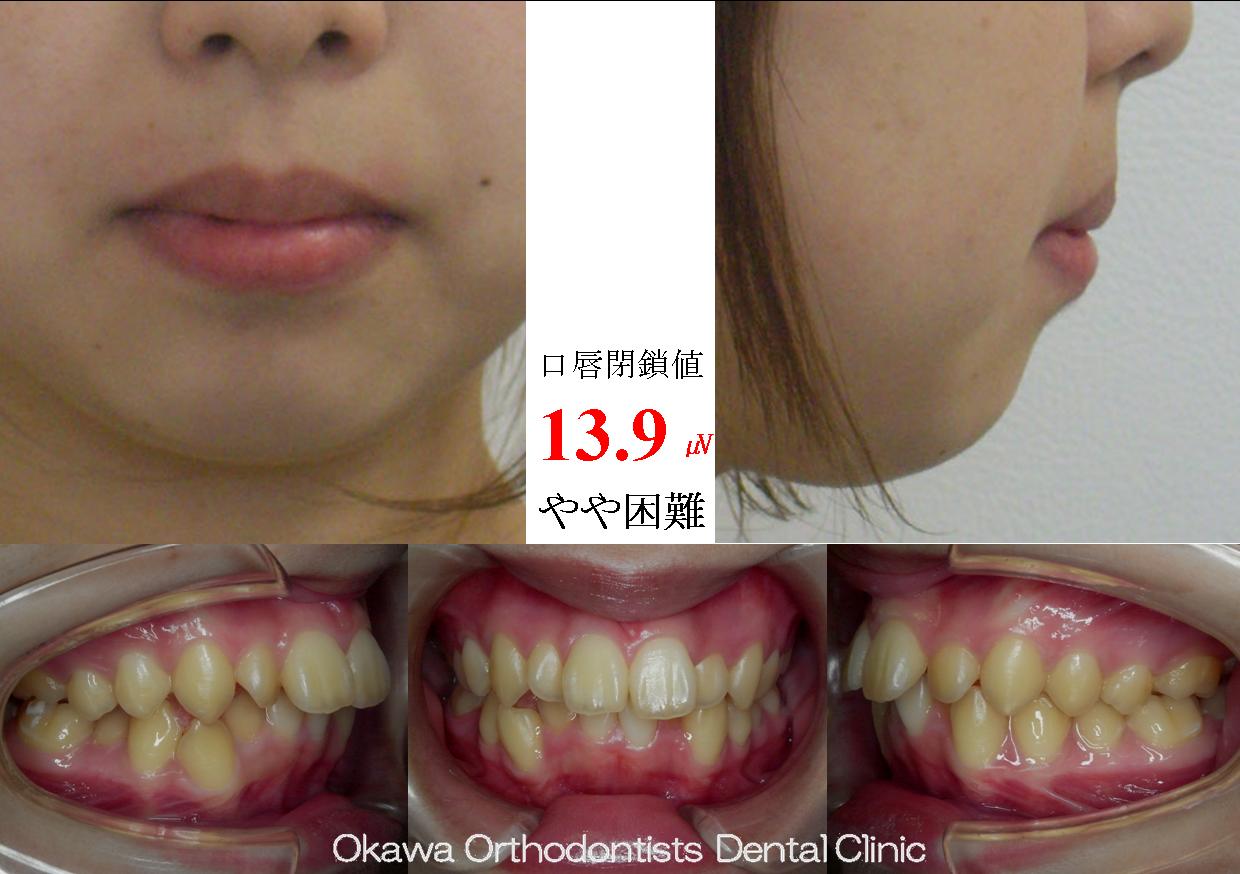 95．叢生と出っ歯も治したいの Before 画像