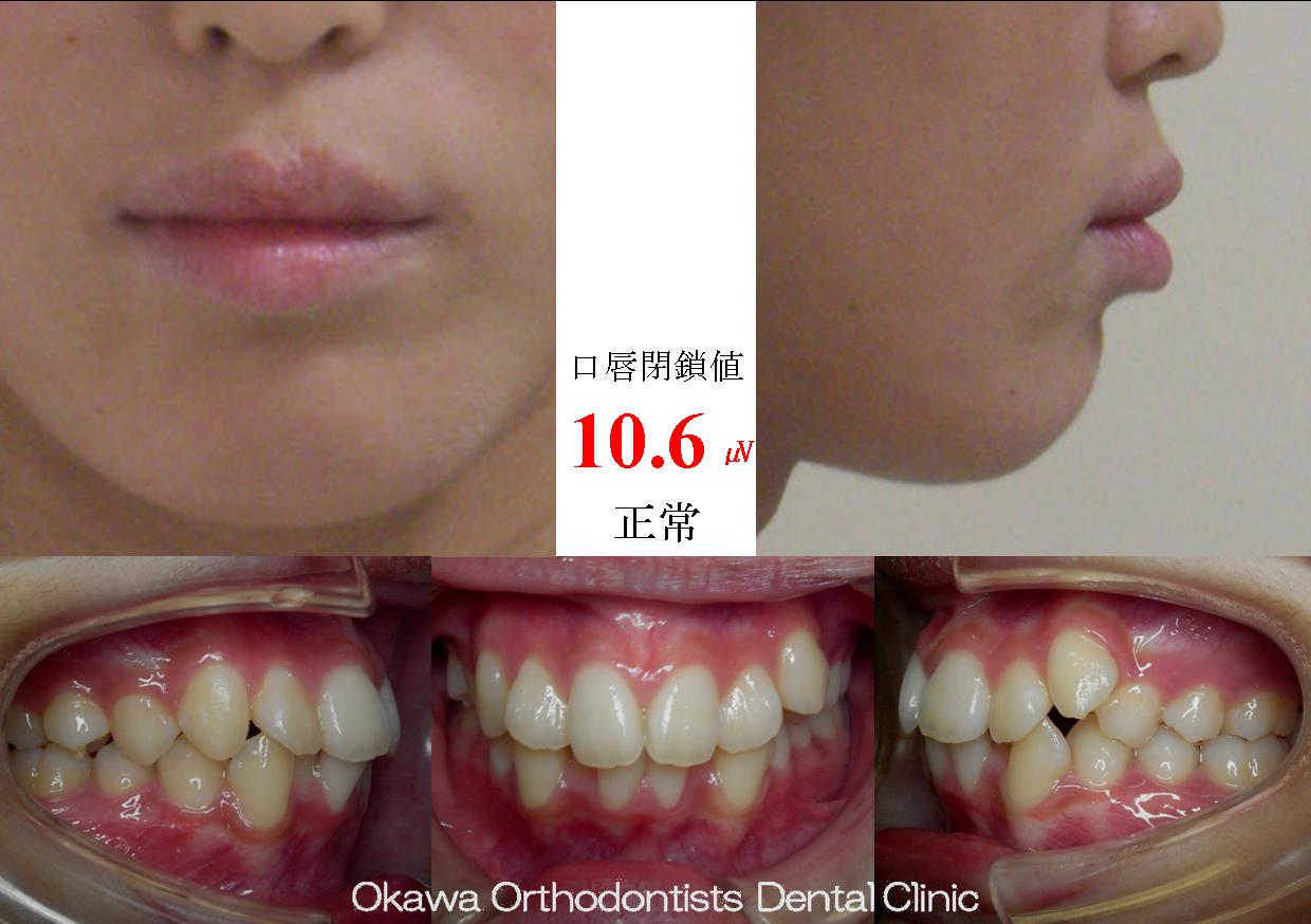 99. 歯が大きく叢生、出っ歯傾向の Before 画像