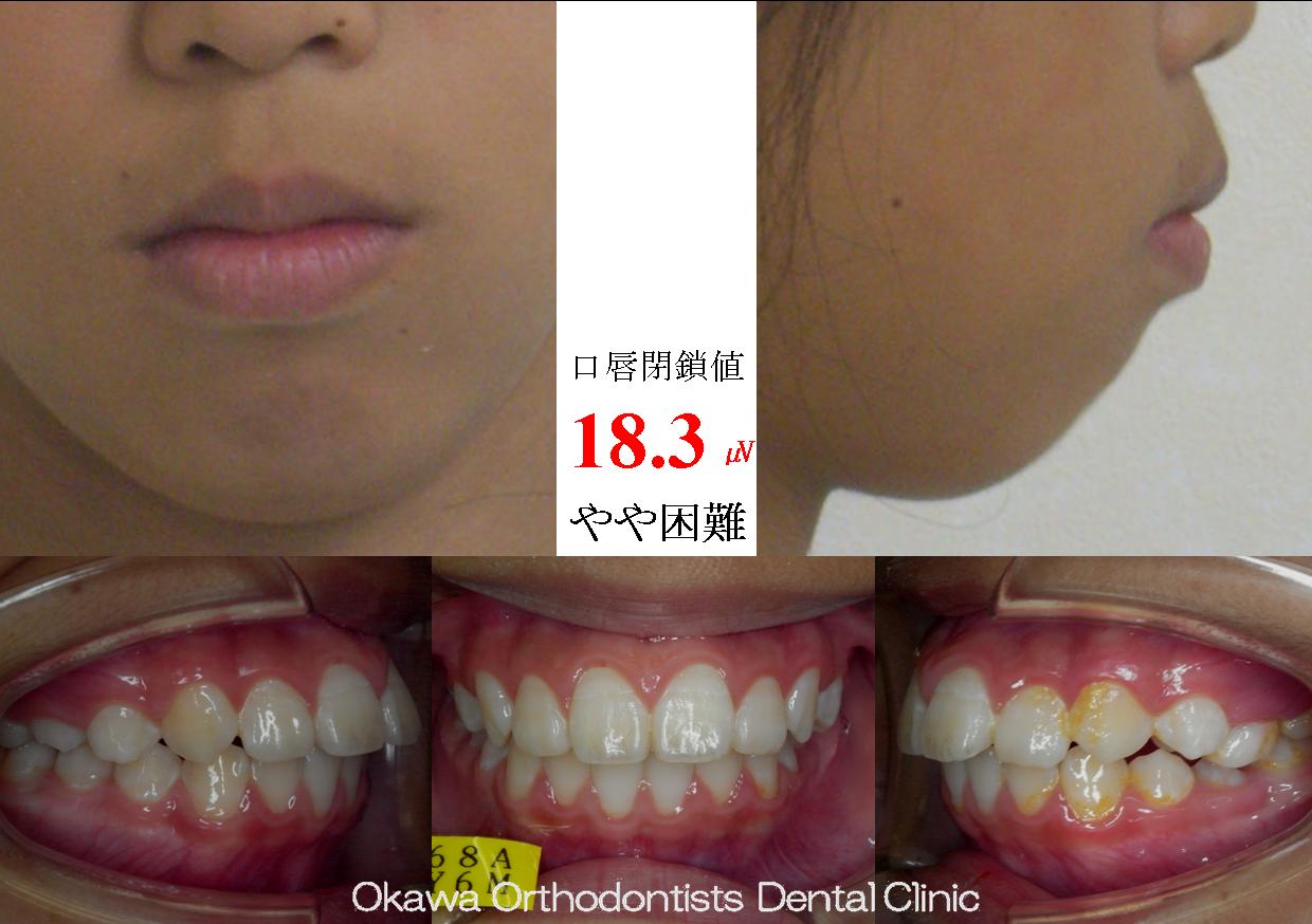 112.口元が出ているの Before 画像