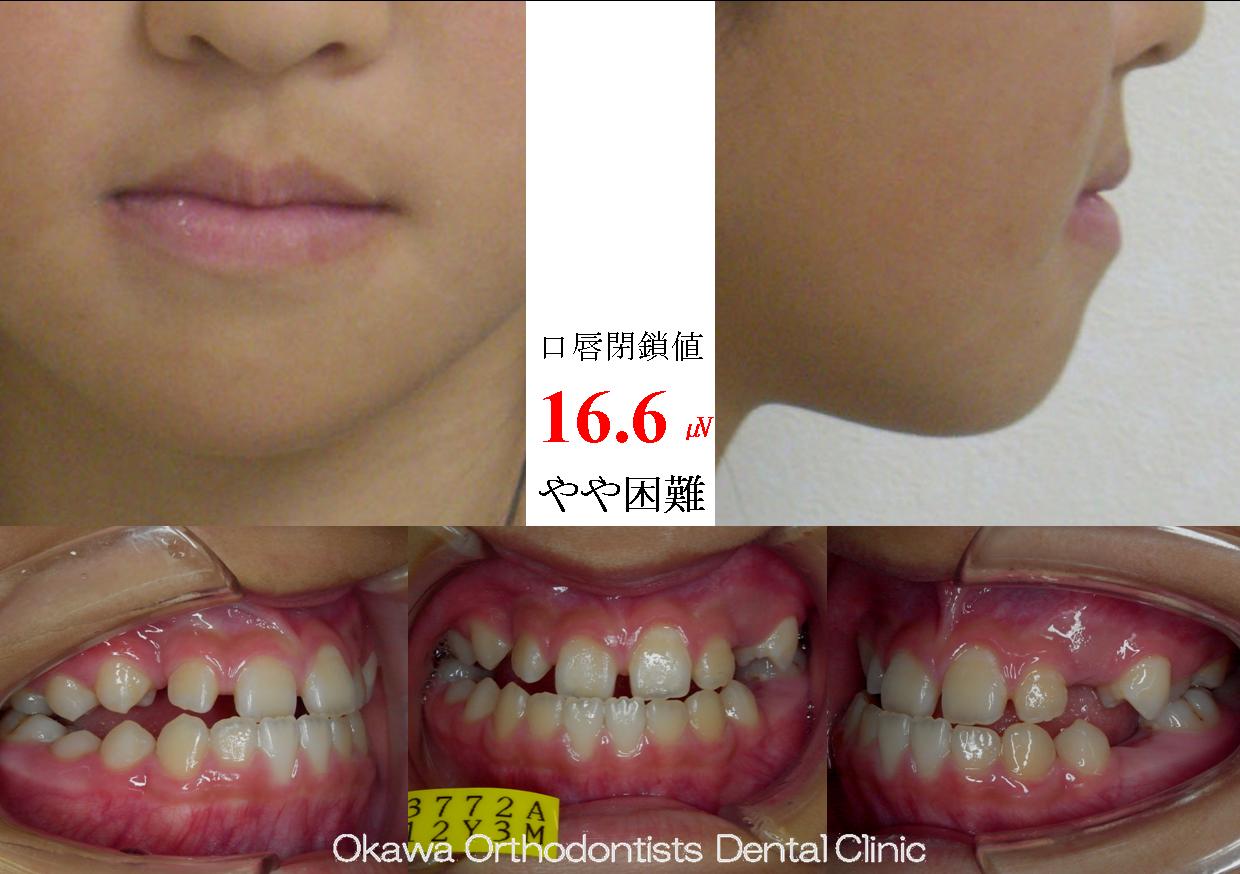 114.良い協力で外科や抜歯が避けられたの Before 画像