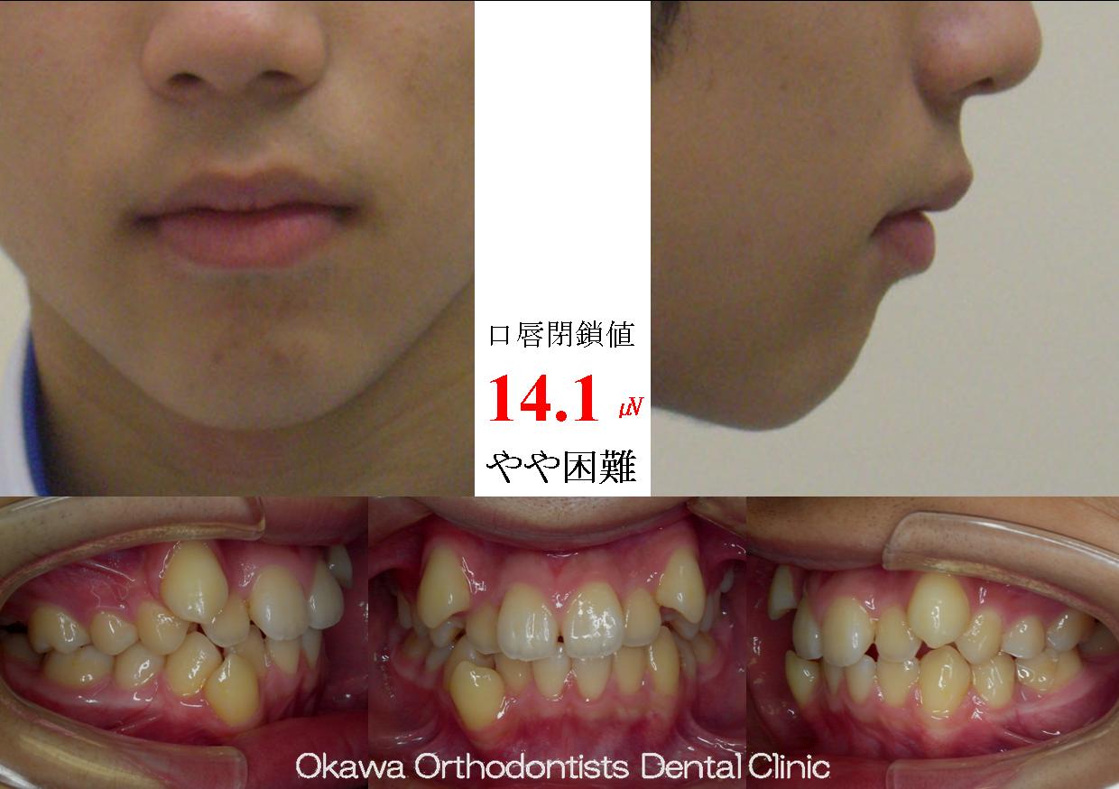 116.歯が大きい八重歯の Before 画像