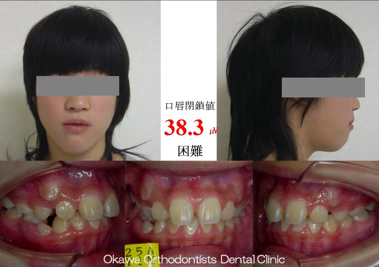 125. 歯の生える隙間がかなり足りなかったの Before 画像