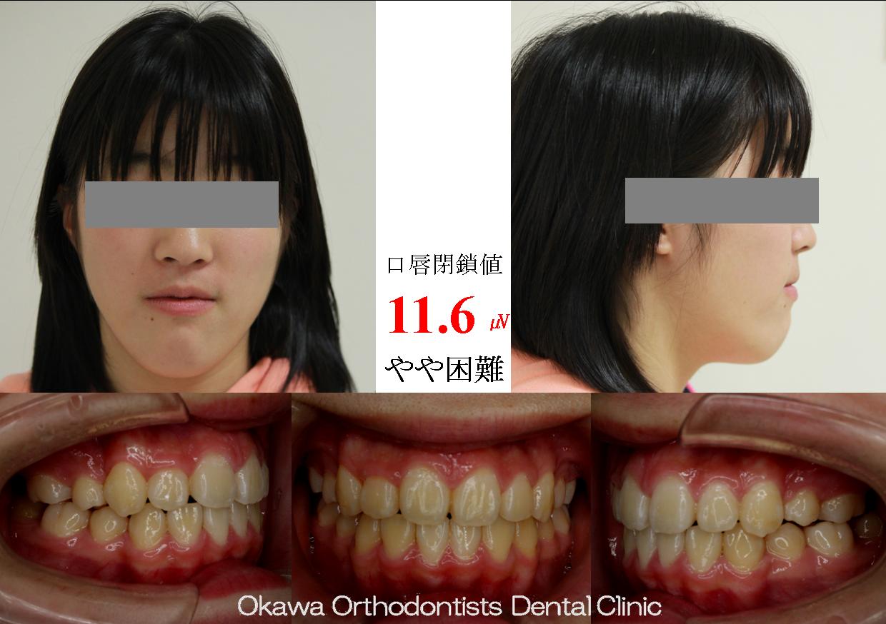125. 歯の生える隙間がかなり足りなかったの After 画像