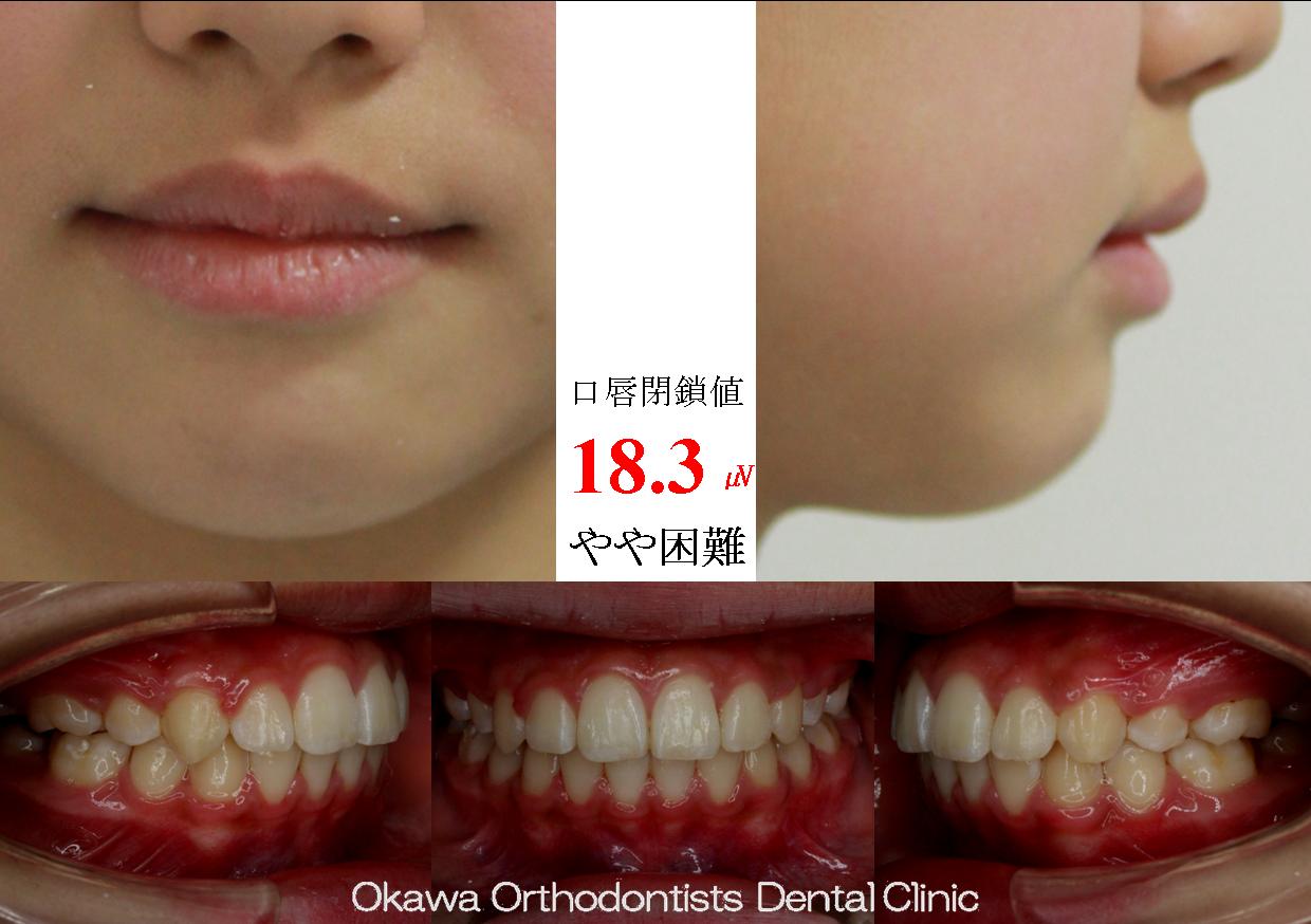 132. Ⅱ期での治療方針は抜歯の After 画像