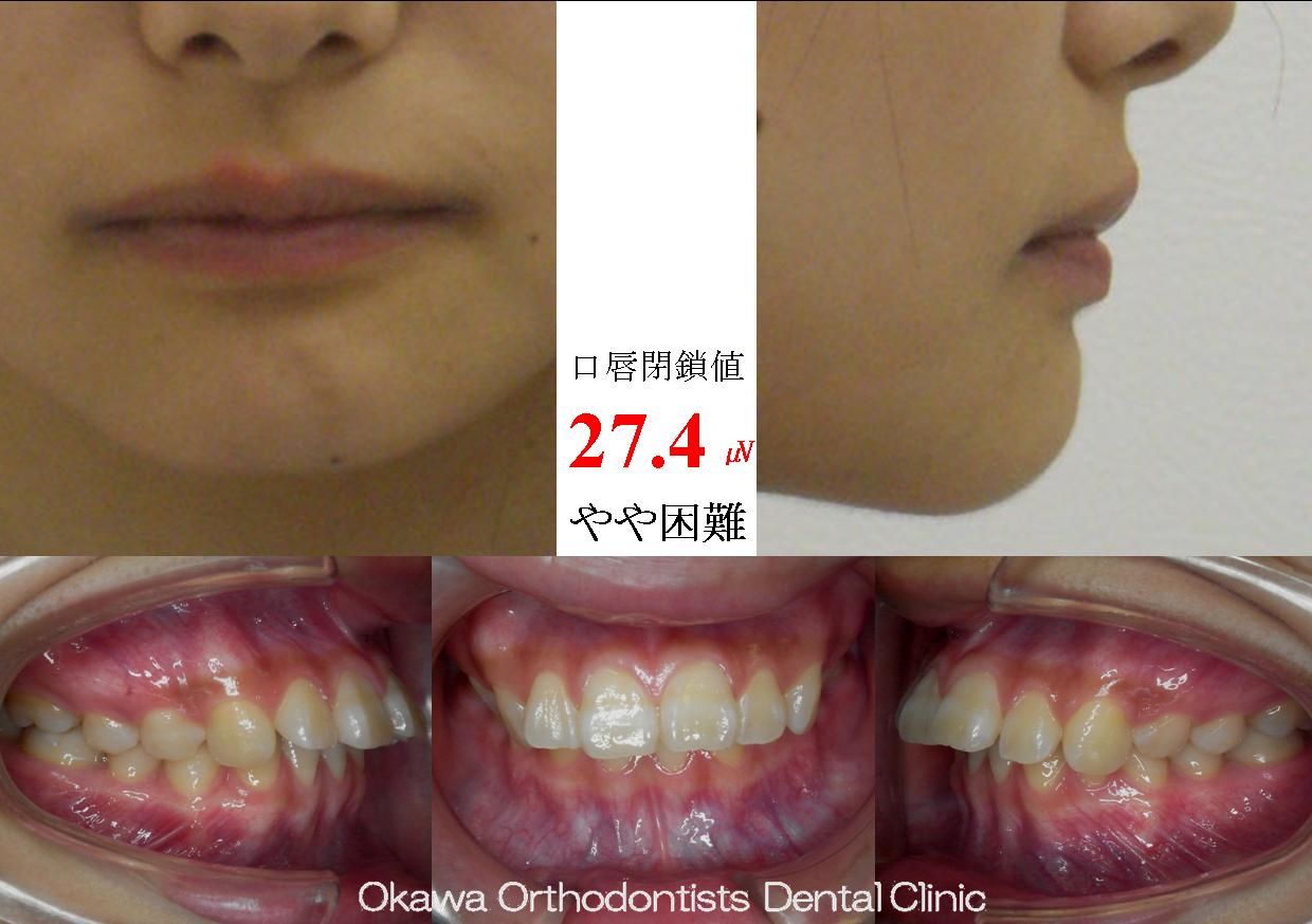 134.下顎の前歯が２本の出っ歯の Before 画像