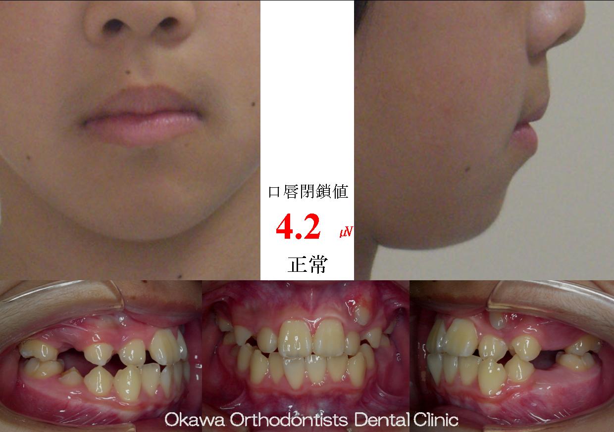 138.初診からの期間は長いの Before 画像