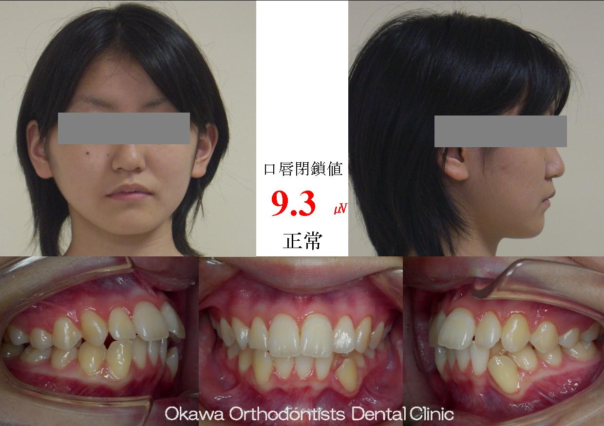 135.正中のずれが大きい叢生の Before 画像