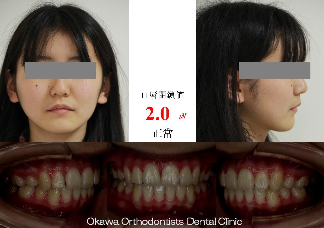 135.正中のずれが大きい叢生の After 画像