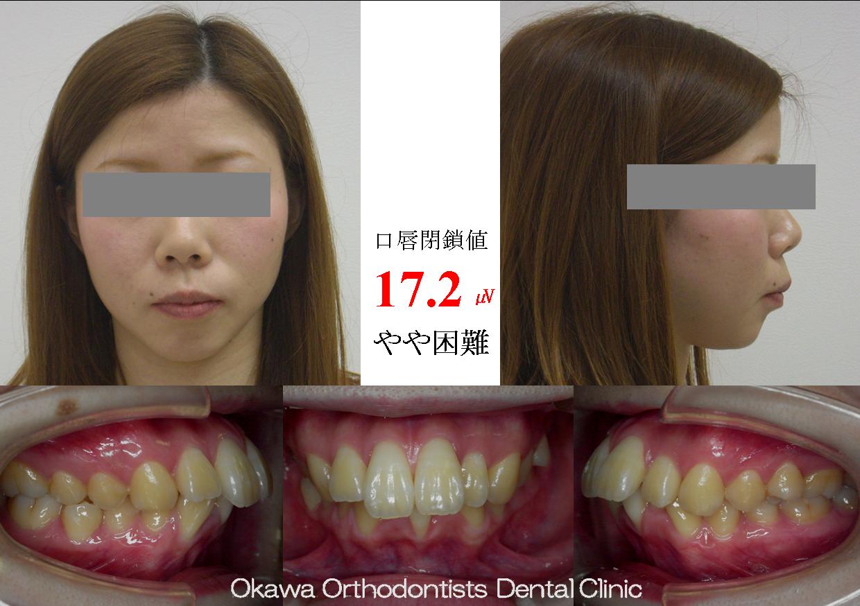136. 前歯が出て長く見えるの Before 画像