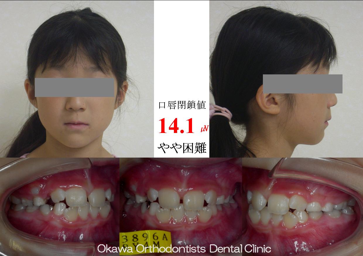 141. むし歯で苦労しましたの Before 画像