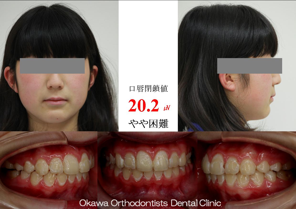 141. むし歯で苦労しましたの After 画像