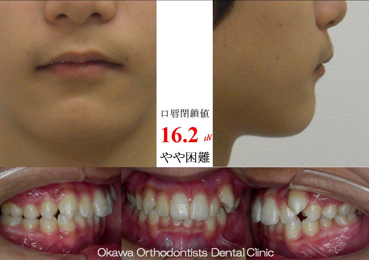 143.左側だけの八重歯の Before 画像