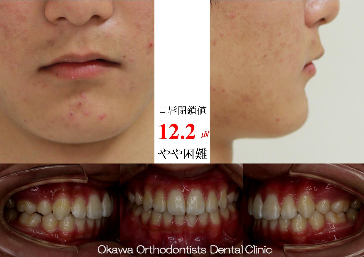 143.左側だけの八重歯の After 画像