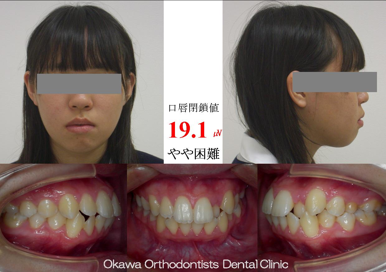 146. 良好なE_ラインの Before 画像