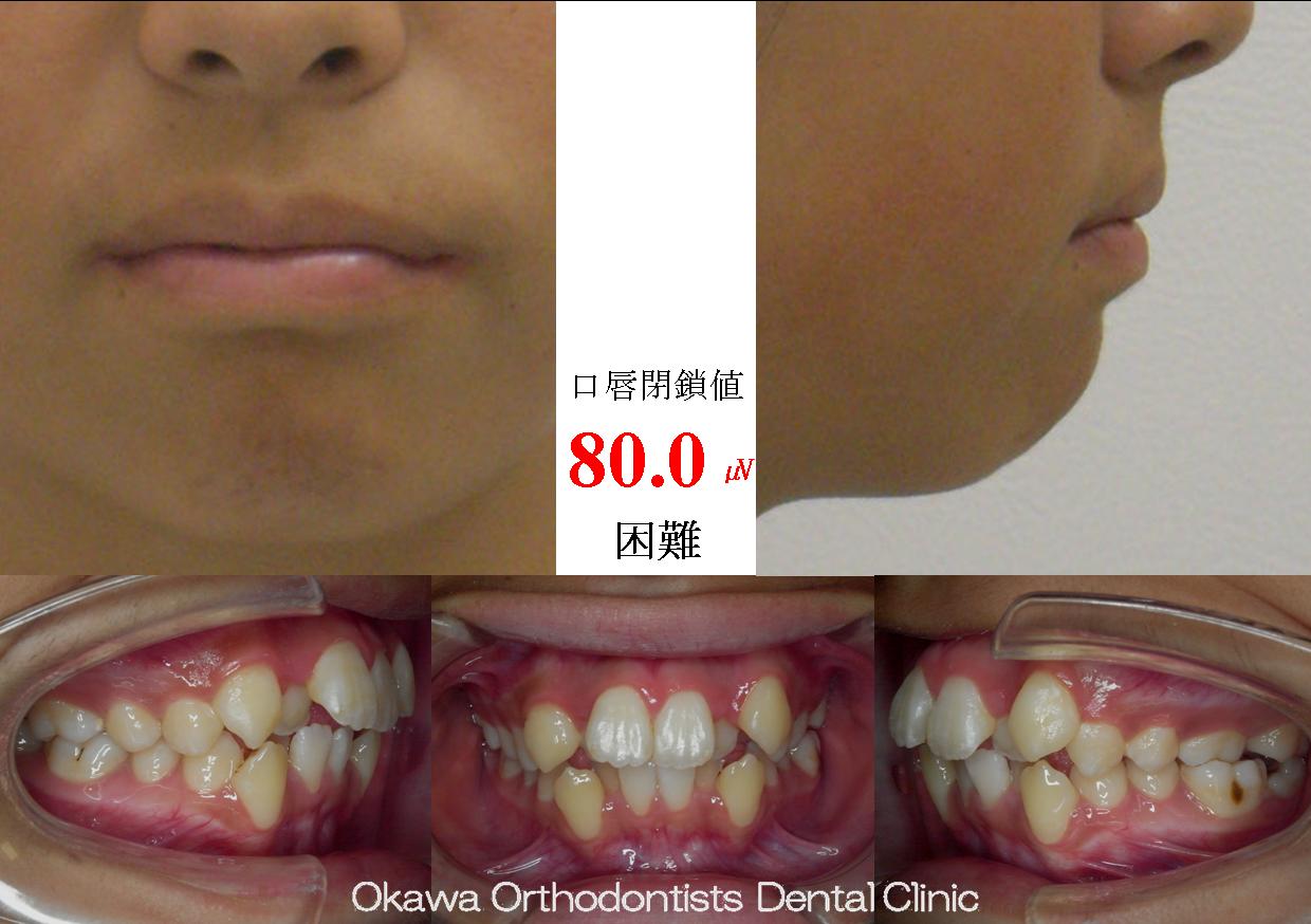 150. 治療開始前からの歯根吸収の Before 画像