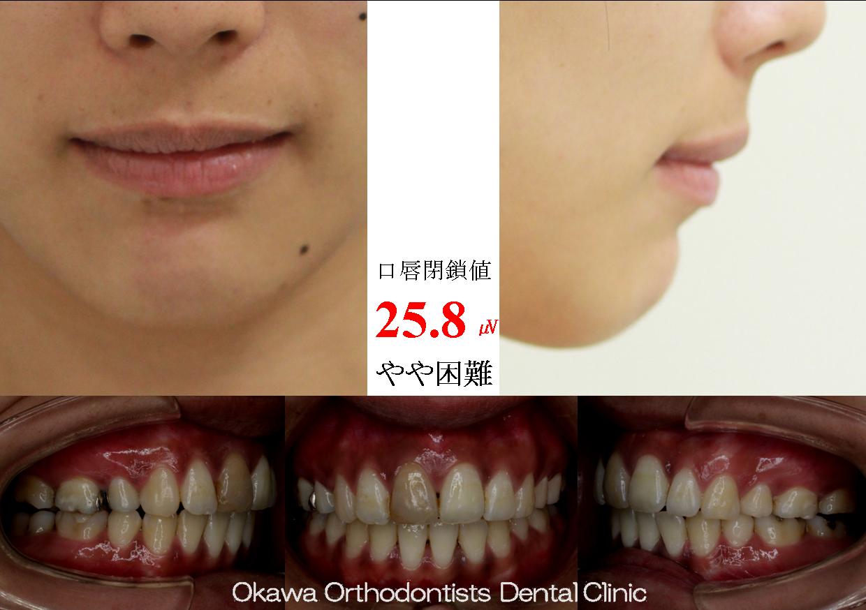 154. 3年を超えてしまった治療期間の After 画像