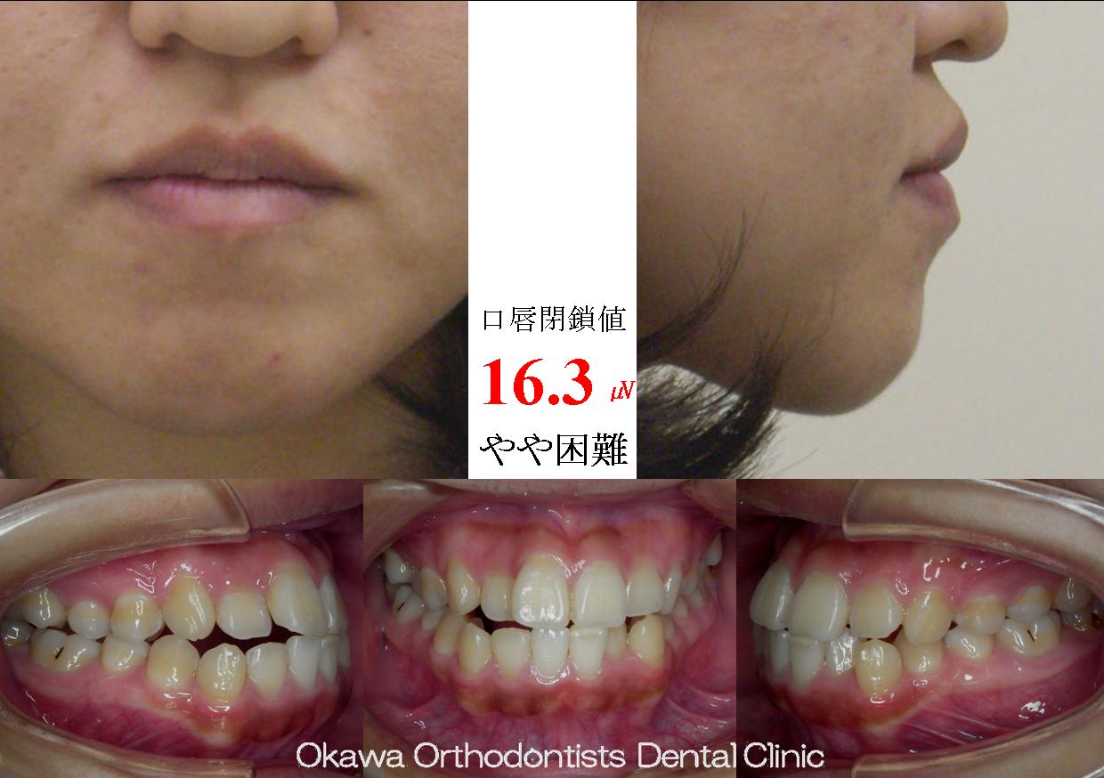 163. 反対咬合ぎみ叢生の Before 画像