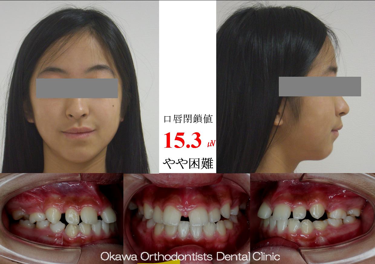 162. 10歯の先天欠如の Before 画像