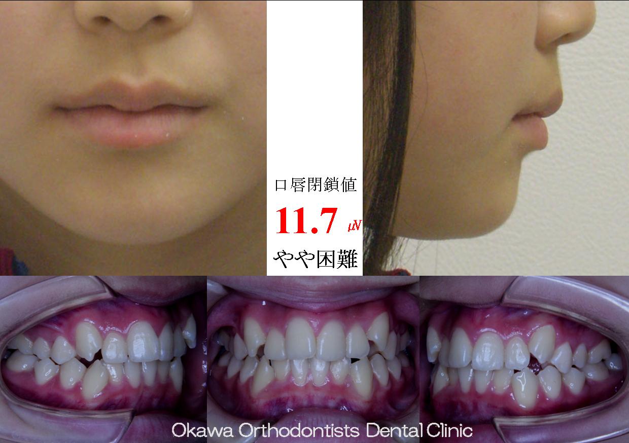 169. 非抜歯による治療の Before 画像