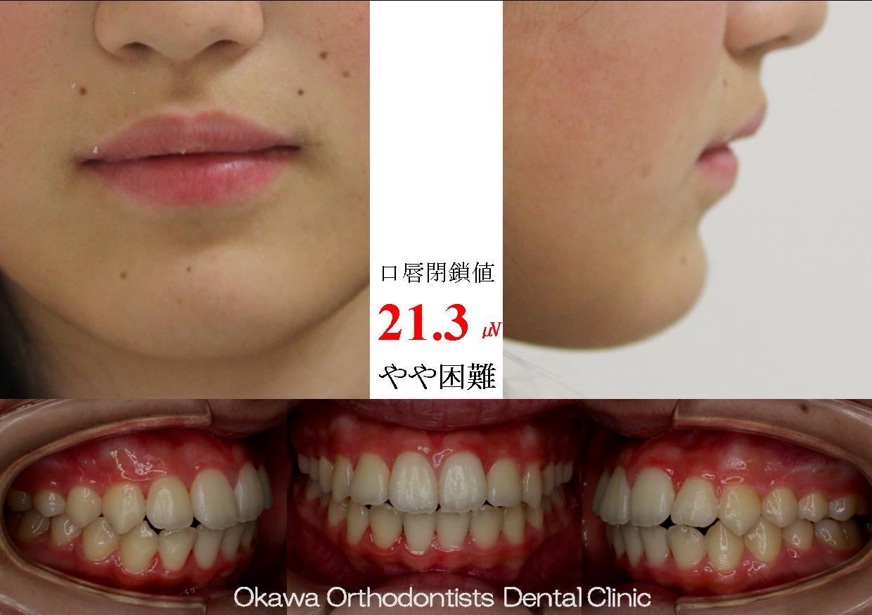 176. 非抜歯だが口元があまり出なかったの After 画像
