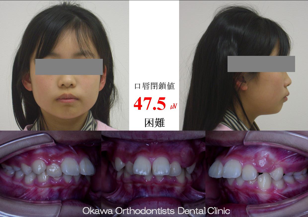 188.学校検診で指摘の Before 画像