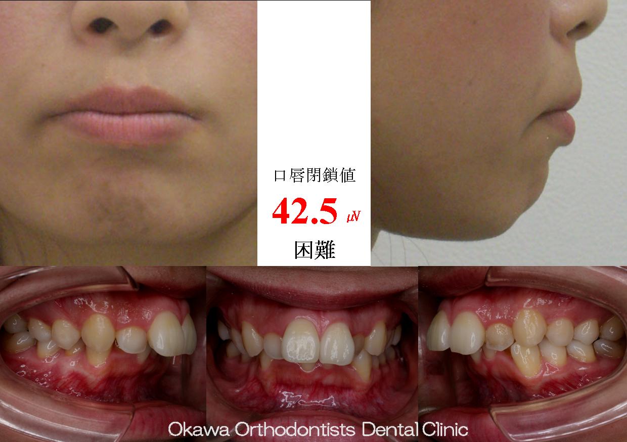 202.出っ歯、口唇閉鎖不全の Before 画像