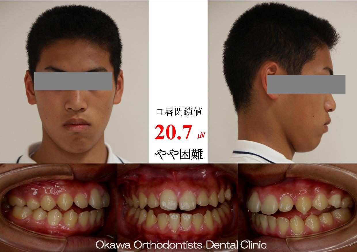 205. 非抜歯での開咬症例の Before 画像