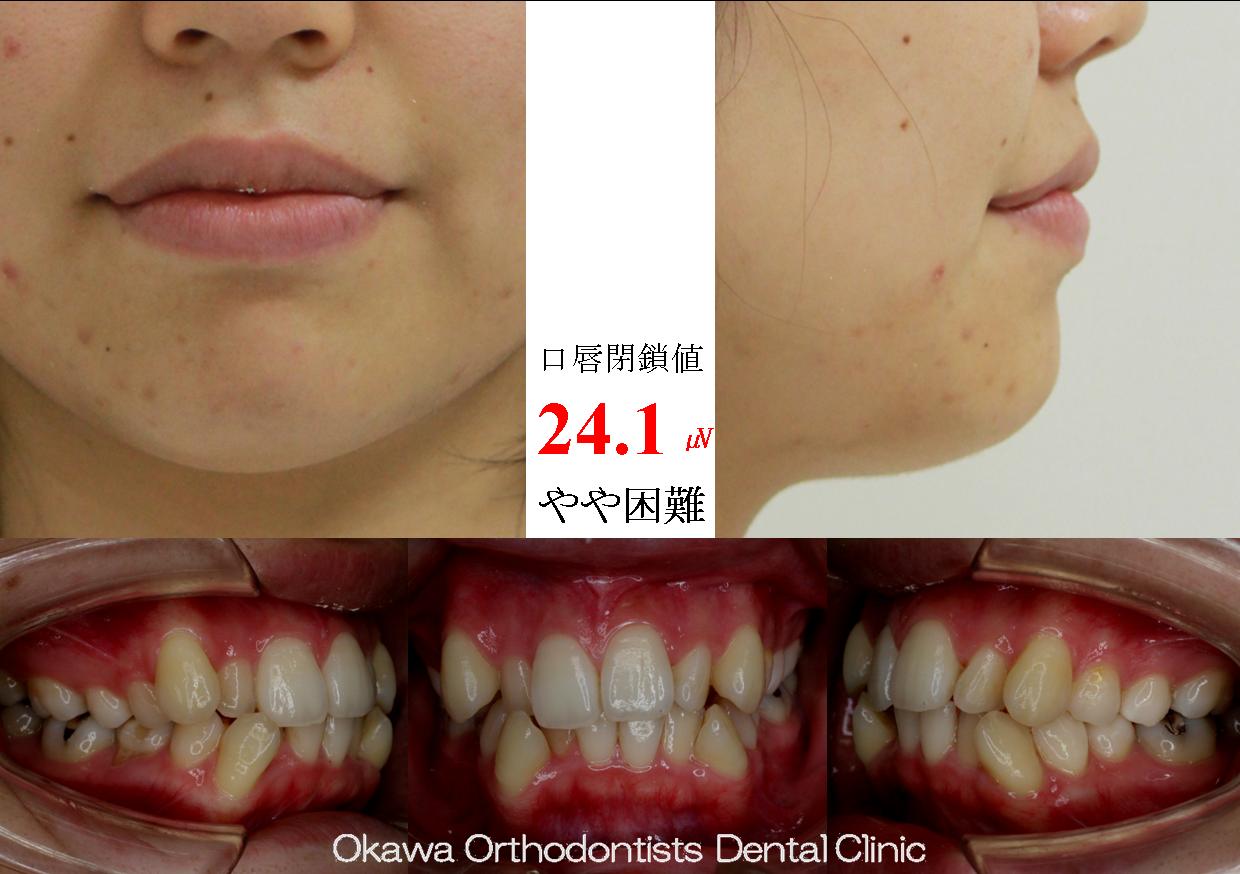 210. 叢生の他に右下第小臼歯の先天欠如の Before 画像
