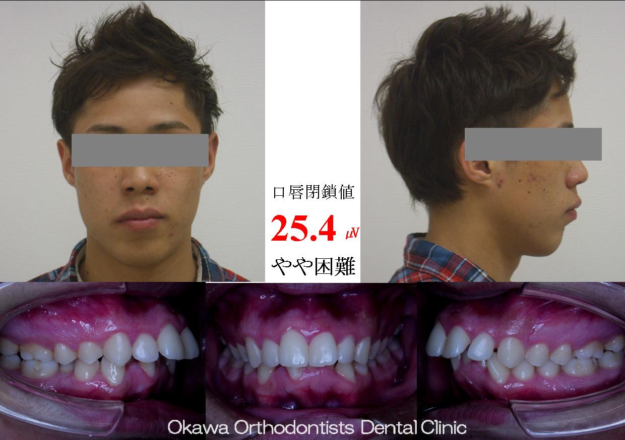 215. 治療途中でガミーの相談の Before 画像