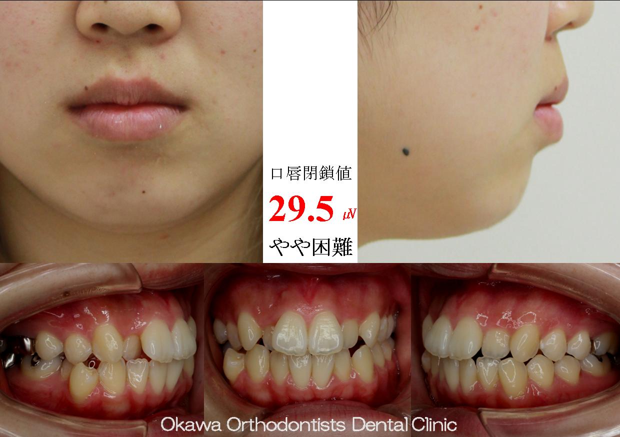 242. 検査から装置装着まで１年の Before 画像