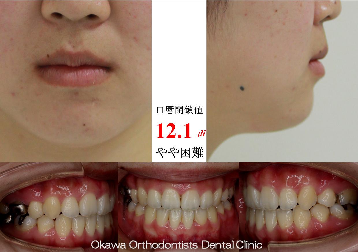 242. 検査から装置装着まで１年の After 画像