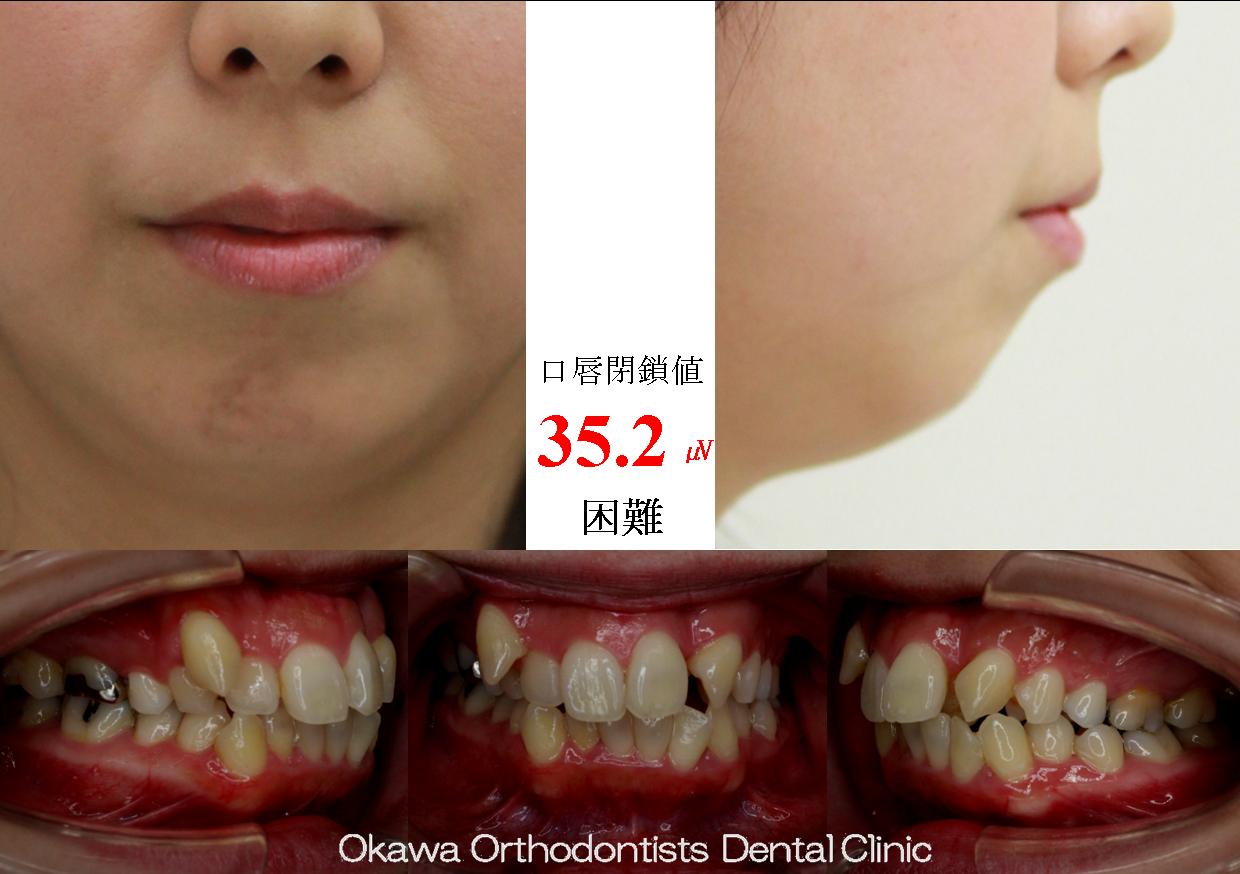 239. 左側の咬合関係が厳しいの Before 画像