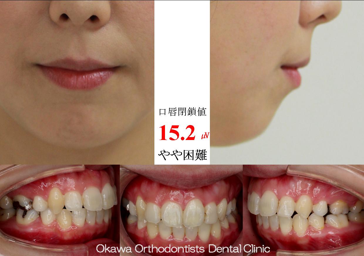 239. 左側の咬合関係が厳しいの After 画像