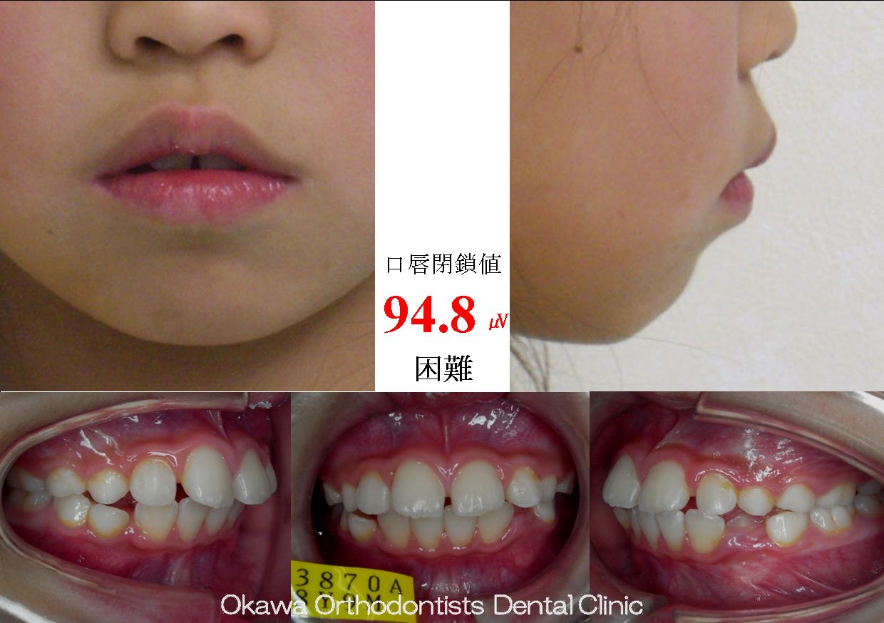 251. 上下顎前突の Before 画像